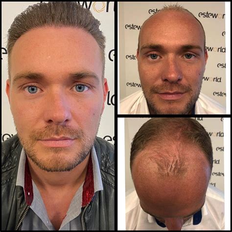 Haartransplantatie En Leeftijd: Speelt Het Een Rol?