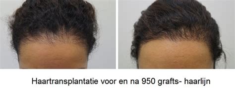 Haartransplantatie Voor Dames: De Veelgestelde Vragen
