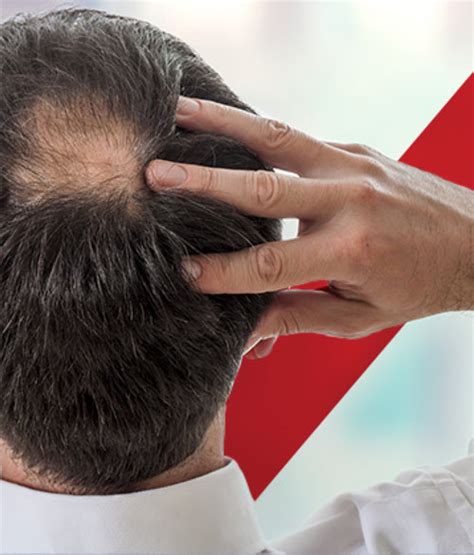 Haartransplantatie Voor Mannen: Wat Zijn De Mogelijkheden?